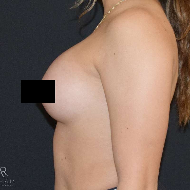 Patient #959 after breast augmentation, side view