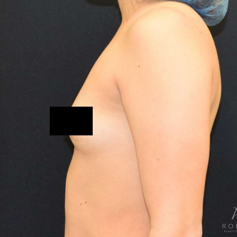 Patient #959 before breast augmentation, side view
