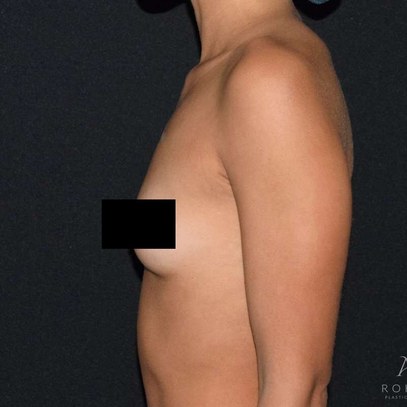 Patient #966 before breast augmentation, side view
