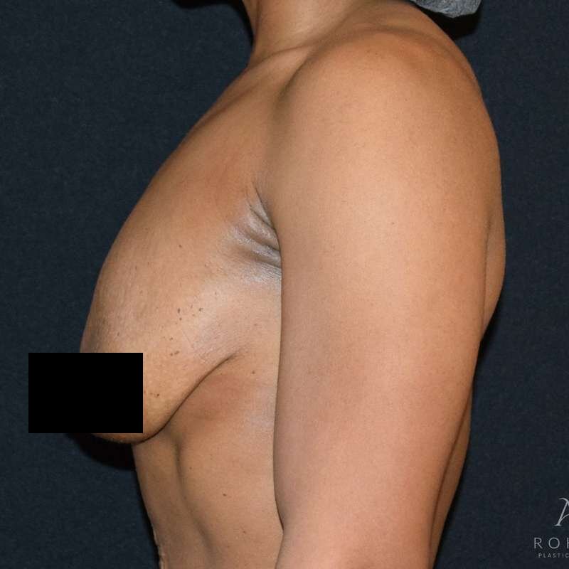 Patient #875 before breast lift surgery, side view