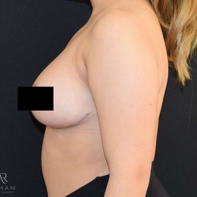 Patient #917 after breast reduction surgery, side view