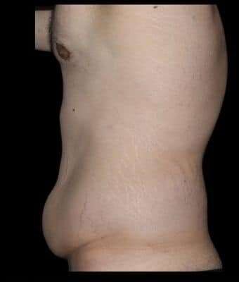 Patient #756 before tummy tuck surgery, side view