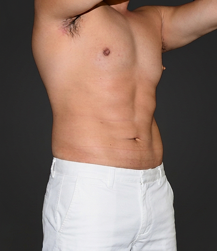 The same male patient after abdominal body-contouring surgery, showing a flatter, more defined midsection