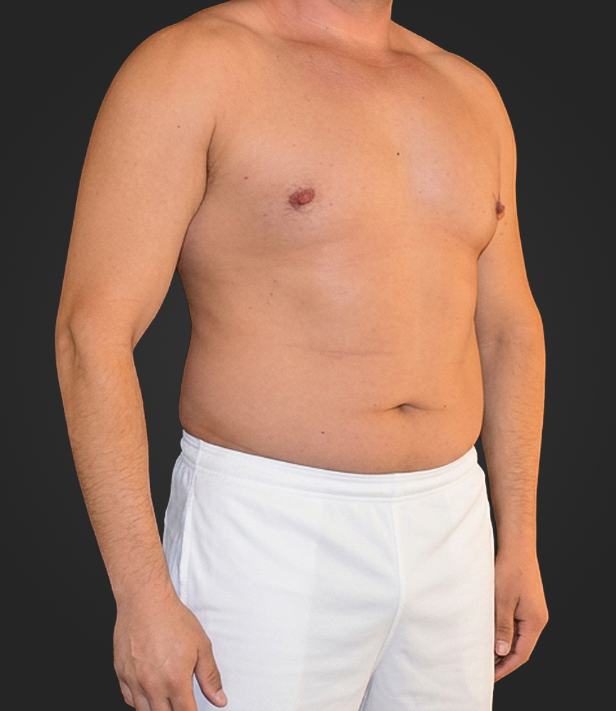 Male patient before abdominal body-contouring surgery, front three-quarter view