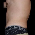 Tummy Tuck Before & After Patient #756