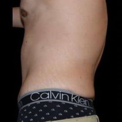 Tummy Tuck Before & After Patient #756