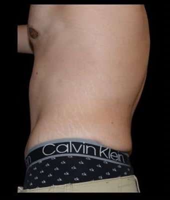 Tummy Tuck Before & After Patient #756
