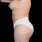Tummy Tuck Before & After Patient #763