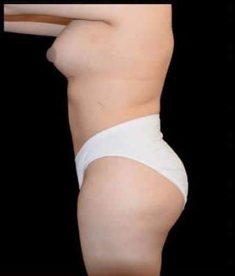 Tummy Tuck Before & After Patient #763