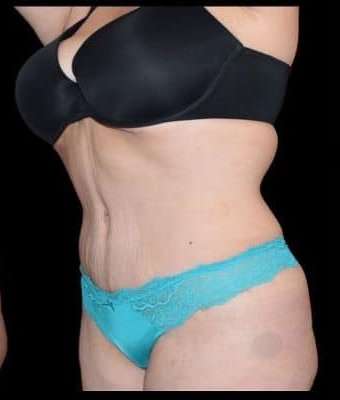 Tummy Tuck Before & After Patient #770