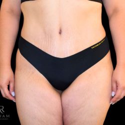 Tummy Tuck Before & After Patient #777