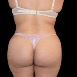 Brazilian Butt Lift Before & After Patient #784