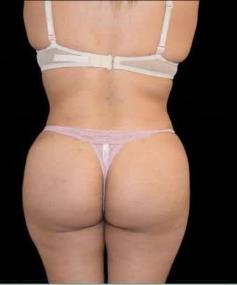 Brazilian Butt Lift Before & After Patient #784