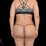 Brazilian Butt Lift Before & After Patient #791