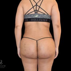 Brazilian Butt Lift Before & After Patient #791