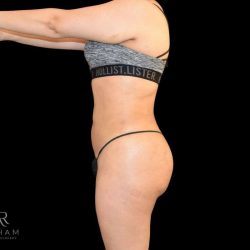 Liposuction Before & After Patient #819