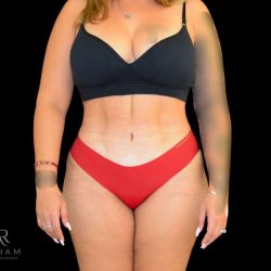 Liposuction Before & After Patient #826