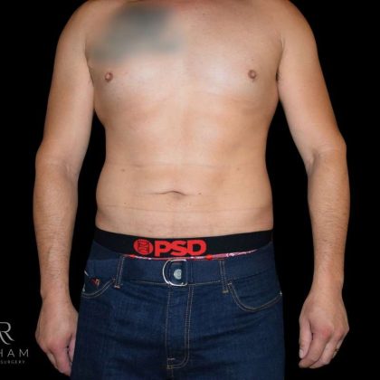 Liposuction Before & After Patient #833