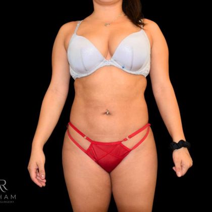 Liposuction Before & After Patient #840