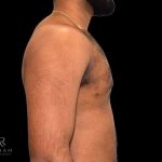 Gynecomastia Before & After Patient #854