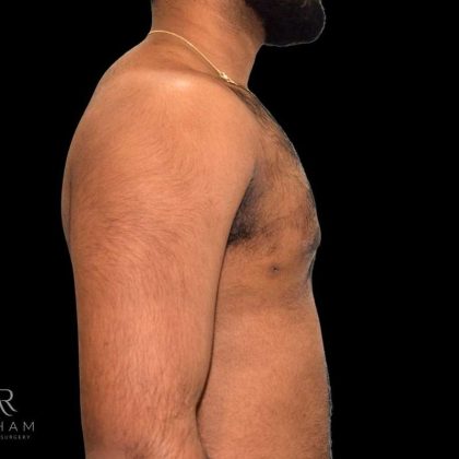 Gynecomastia Before & After Patient #854