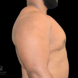 Gynecomastia Before & After Patient #861