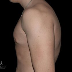 Gynecomastia Before & After Patient #868