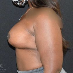 Breast Lift Before & After Patient #889