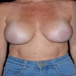 Breast Augmentation Before & After Patient #980