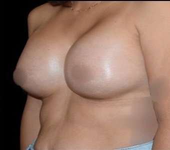 Breast Augmentation Before & After Patient #992