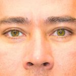 Blepharoplasty Before & After Patient #995