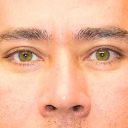 Blepharoplasty Before & After Patient #995