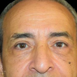 Blepharoplasty Before & After Patient #1000