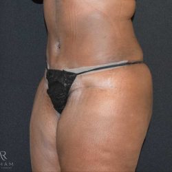 Tummy Tuck Before & After Patient #737
