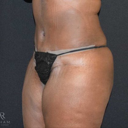 Tummy Tuck Before & After Patient #737