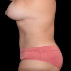 Tummy Tuck Before & After Patient #744