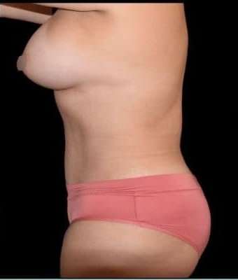 Tummy Tuck Before & After Patient #744