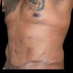 Tummy Tuck Before & After Patient #749