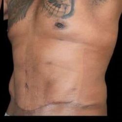 Tummy Tuck Before & After Patient #749