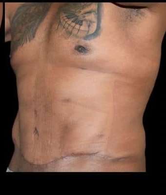 Tummy Tuck Before & After Patient #749
