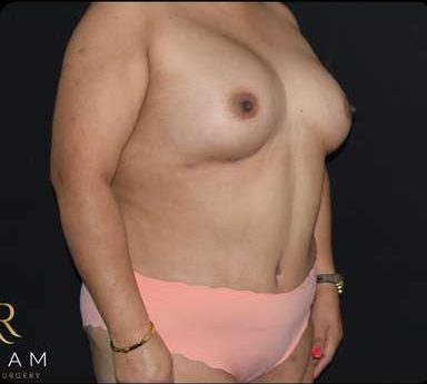 Mommy Makeover Before & After Patient #383