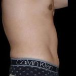 Tummy Tuck Before & After Patient #756
