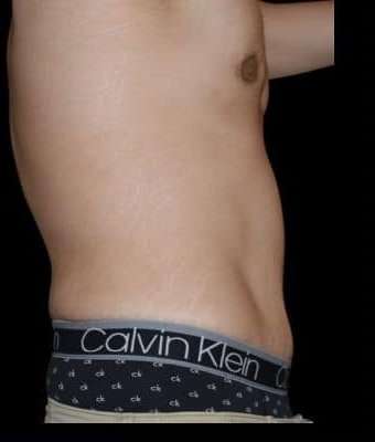 Tummy Tuck Before & After Patient #756