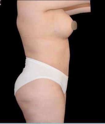 Tummy Tuck Before & After Patient #763