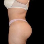 Brazilian Butt Lift Before & After Patient #784