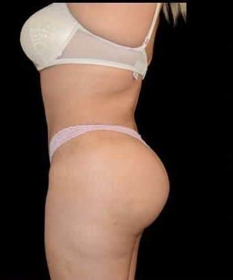 Brazilian Butt Lift Before & After Patient #784