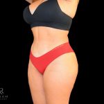 Brazilian Butt Lift Before & After Patient #798