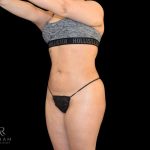 Liposuction Before & After Patient #819