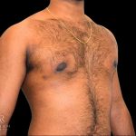 Gynecomastia Before & After Patient #854