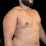 Gynecomastia Before & After Patient #861